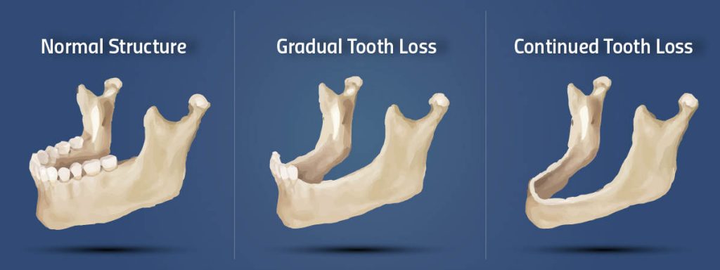 bone grafts in dentistry