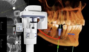 3D CT-Scan for Dental Implant Surgery