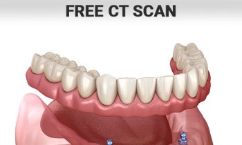 ct scan for dental implants