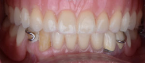 upper implant dentures cost