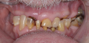 Can I Get Dental Implants With Gum Disease