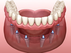 implant supported dentures cost