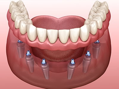 all on dental implants