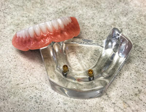 Snap in dentures