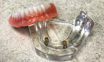 snap on dentures