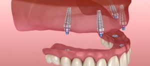 whole mouth dental implants