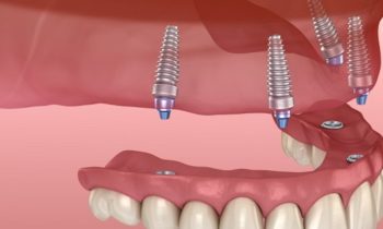 whole mouth dental Implants