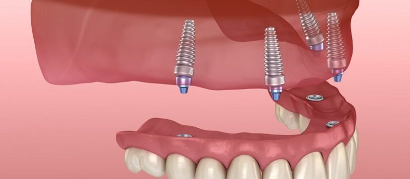 whole mouth dental Implants