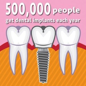 Costo de los Implantes Dentales