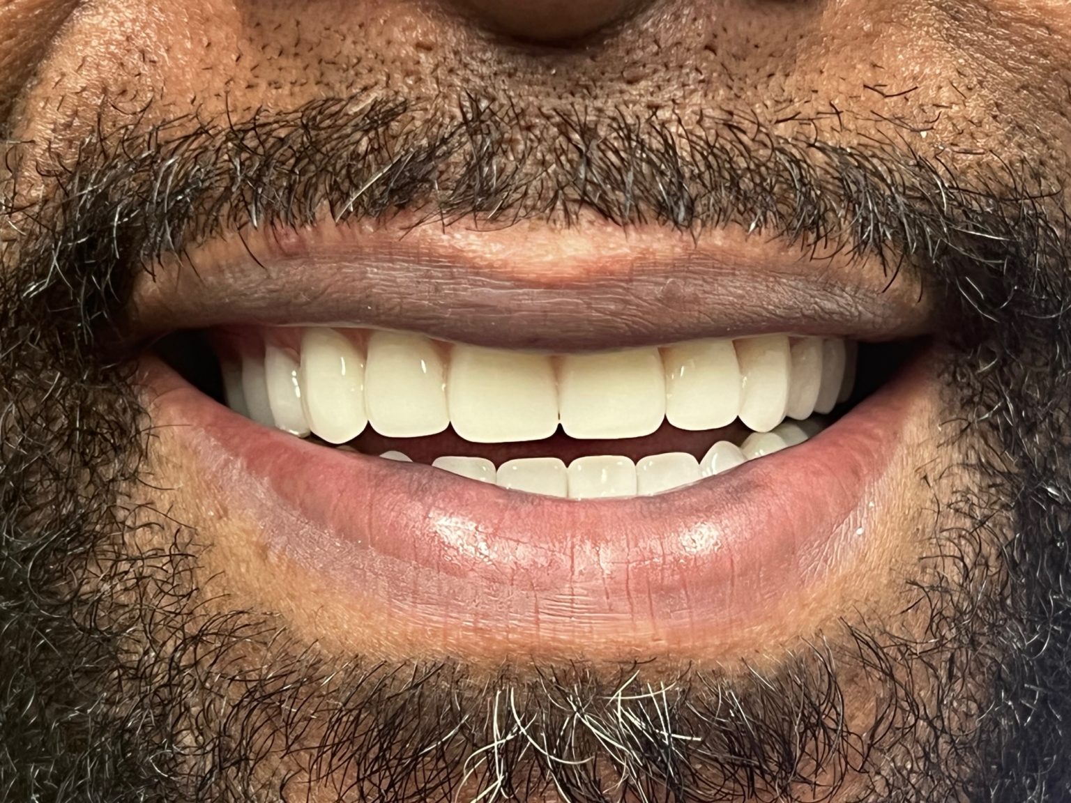 Understanding Immediate Denture Pros, Cons, Cost and More