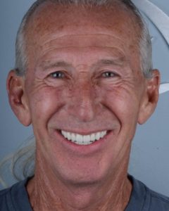 A person smiling with permanent dentures and All-on-4 dental implants