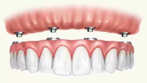 how long does it take to get full mouth dental implants