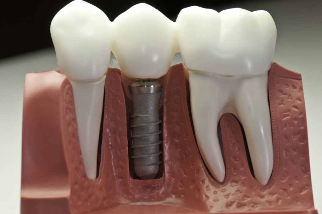 dental implants in my area