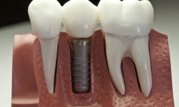 dental implants in my area