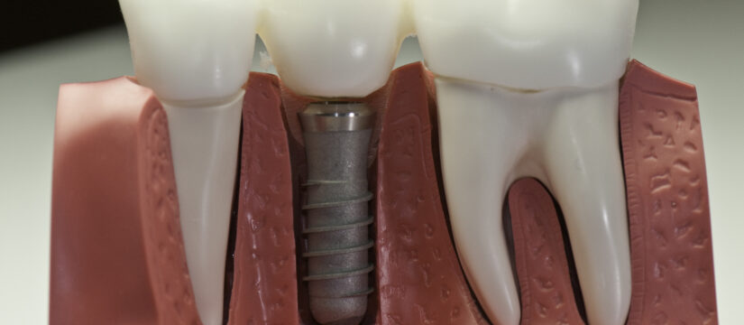 dental implants in my area
