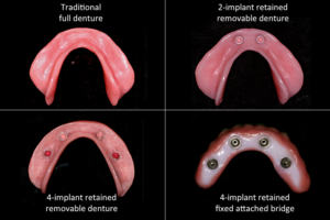lower denture options