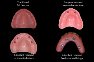 upper denture options