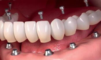 how long does it take to get full mouth dental implants