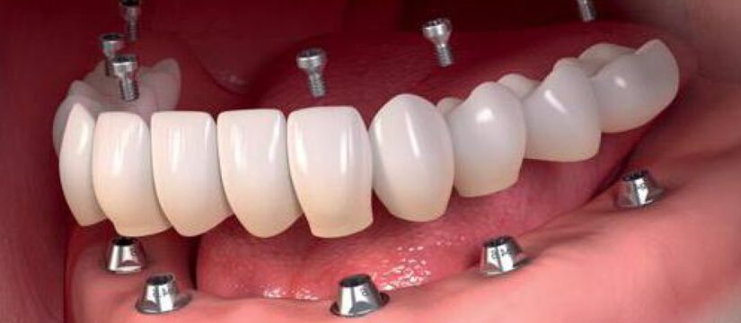how long does it take to get full mouth dental implants