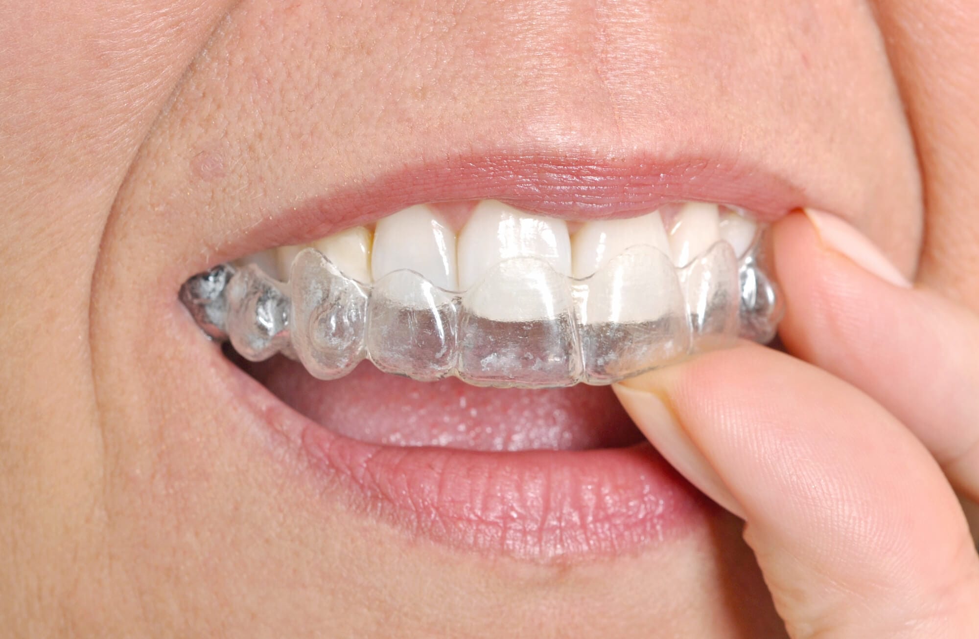 Dental Splint: types, costs, benefits, and how to clean