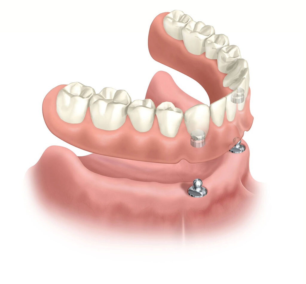 Snap in Denture