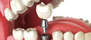 how long does a dental implant last