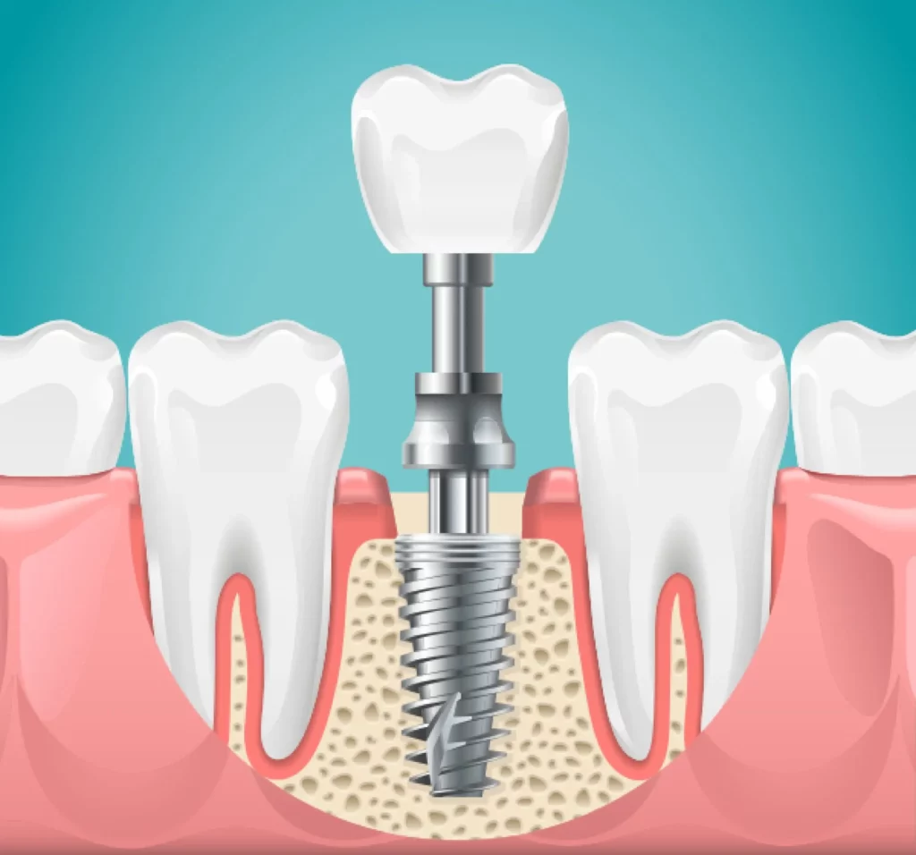 How to Find the Right Dental Implant Specialist