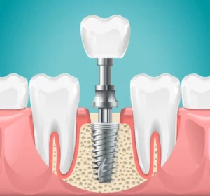 cost of a dental implant