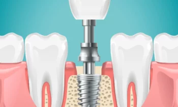 How to Find the Right Dental Implant Specialist