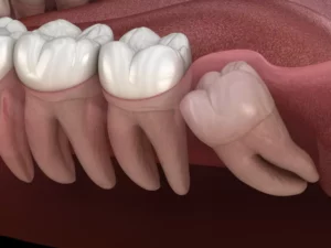 wisdom tooth removal