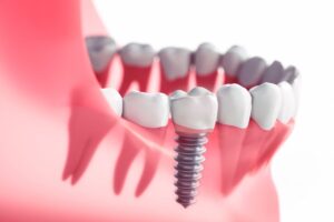 tooth implant process timeline