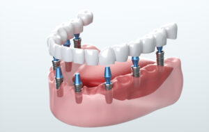 implant for every tooth
