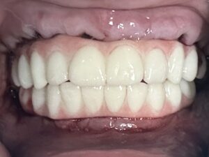 all on-4 vs all on 6 dental implants