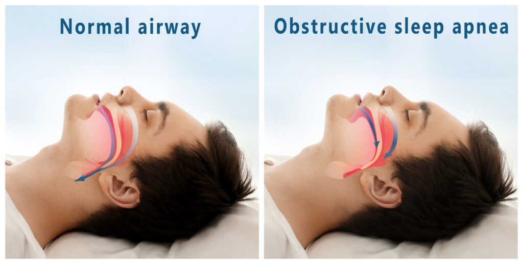 Snore problem concept. Illustration of normal airway and obstructive sleep apnea