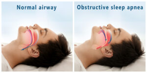 normal airway and obstructive sleep apnea