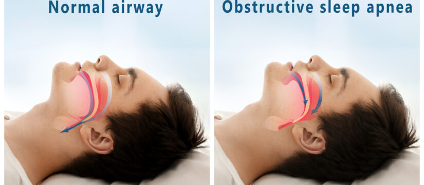 Snore problem concept. Illustration of normal airway and obstructive sleep apnea