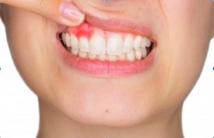 tooth restoration cost