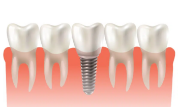Unlock the Benefits of Implant Over Denture for a Secure Smile