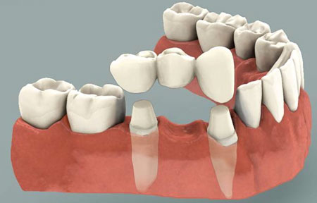 dental bridge