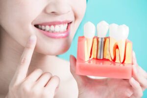 Full Arch Dental Implants A Permanent Solution