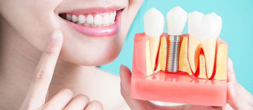 Full Arch Dental Implants A Permanent Solution