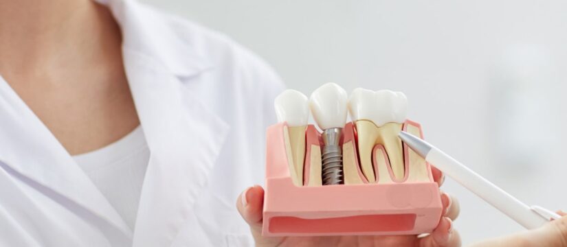Revolutionize Your Smile with Clear Choice Dentistry Same-Day Implants Explained