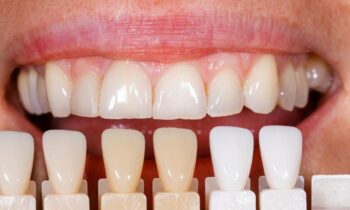 Top Tooth Replacements Your Guide to Smiling with Confidence