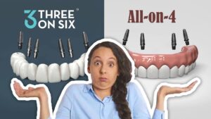 all-on-4 vs all-on-6 dental implants