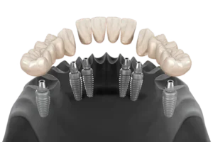what is 3 on 6 dental implants