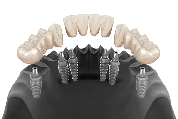 what is 3 on 6 dental implants