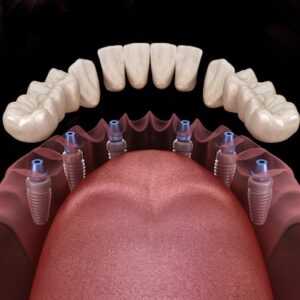 cost of full dental implants