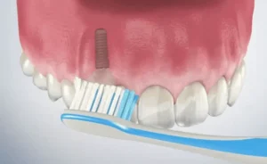 Dental Implant