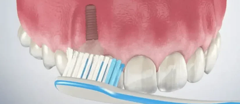 Dental Implant