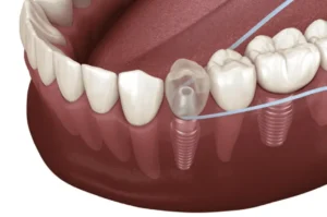 Dental Implant Care